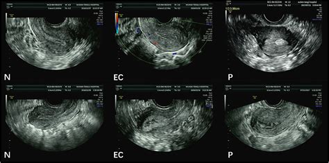 endometrial cancer thickness measurement|2 week wait endometrial cancer.